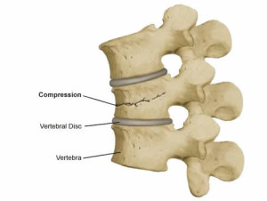 Image of a Compression Fracture