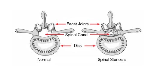 Image of a Healthy Vertebral Disc